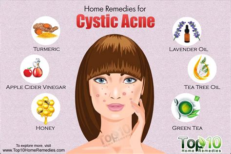 Home Remedies for Cystic Acne | Top 10 Home Remedies