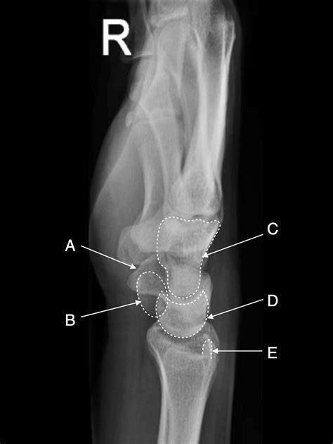 Radiographic Anatomy Of The Skeleton Wrist Lateral View Labelled | Porn ...