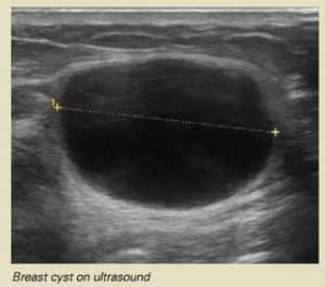 Breast Cyst Ultrasound