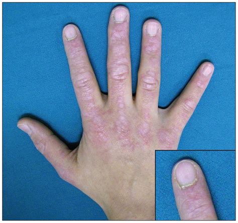 Gottron papules: a pathognomonic sign of dermatomyositis | CMAJ