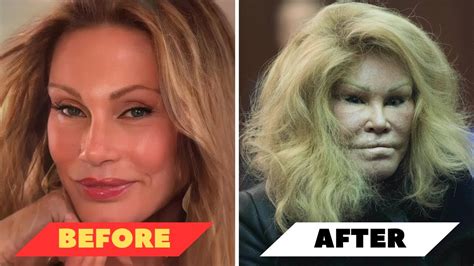 Celebrity Plastic Surgery Before And After Gone Wrong - Infoupdate.org