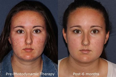 Photodynamic Therapy Acne Treatment | San Diego, CA | CLDerm