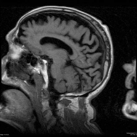 Posterior cortical atrophy | Radiology Case | Radiopaedia.org