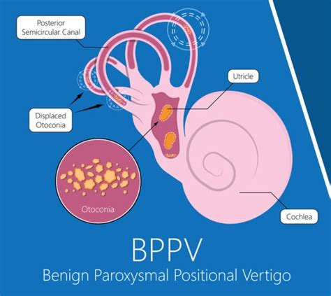 Benign Paroxysmal Positional Vertigo