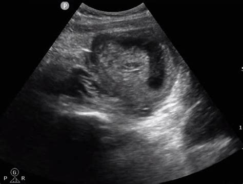 US - Molar Pregnancy: Ultrasound of the Month | LaptrinhX / News