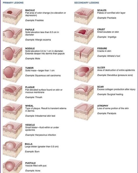 macule patch plaque - Google Search in 2020 | Types of skin rashes ...