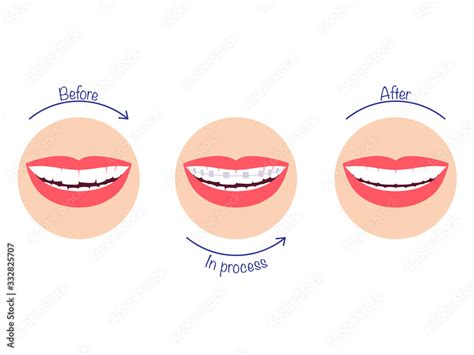 The process of correcting teeth using braces - before and after. Vector ...