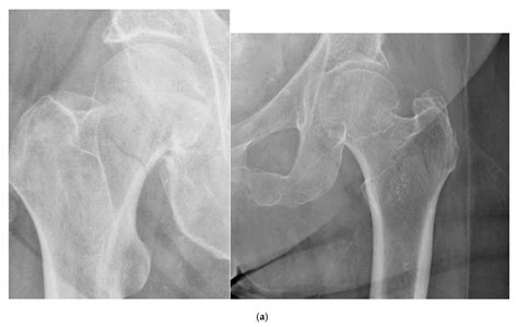 Left Femoral Neck Osteoporosis