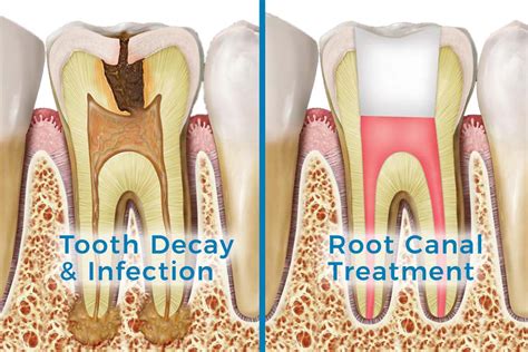 Root Canal (Endodontics) - Family Dentist Serving Morrilton, Perryville ...