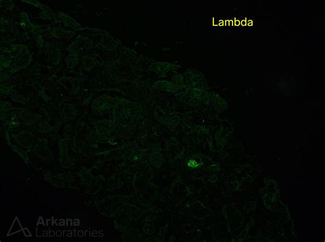 Light Chain Deposition Disease | Teaching Points | Arkana Laboratories