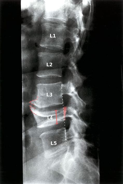 Impacted Fracture X Ray