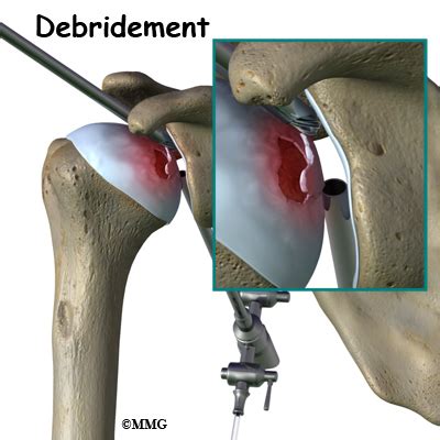 Osteonecrosis of the Humeral Head | Houston Methodist