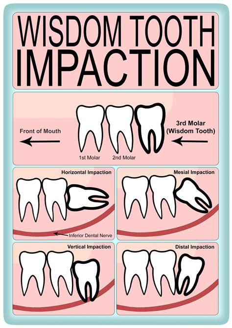 What are the different kinds of wisdom tooth impaction? | Greenlife Dental