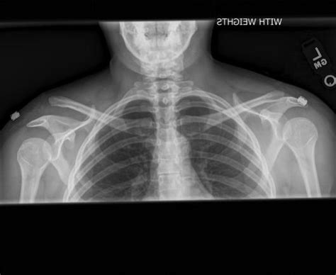 Surgery for a shoulder separation | Dr. David Geier - Sports Medicine ...