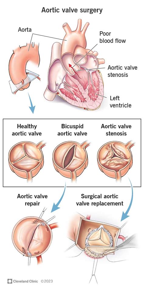 Aortic Valve Anatomy