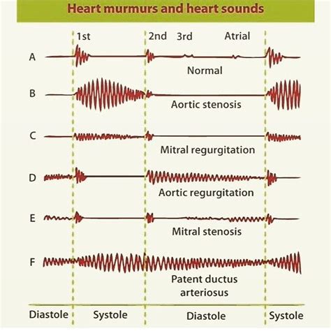 @doctordconline on Instagram: “Heart sounds and Murmurs #heart #sound # ...