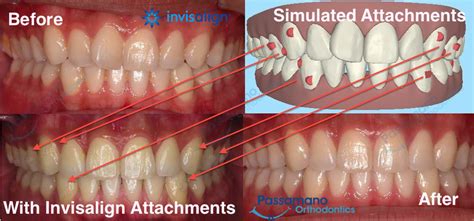 What Are Invisalign Attachments? | Passamano Orthodontics Irvine, CA ...