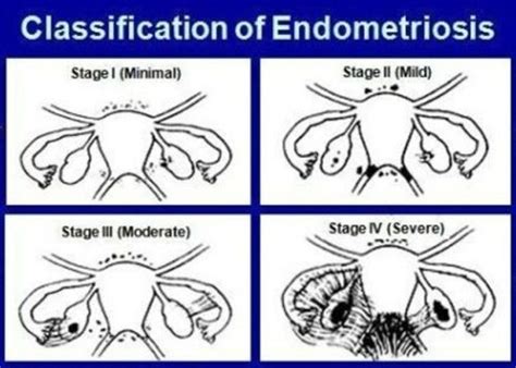 Endometriosis stages and how they are measured