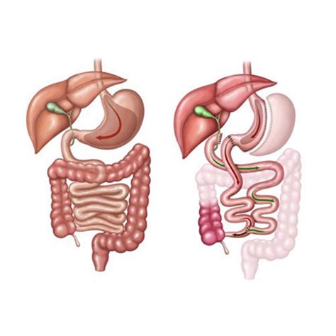 Duodenal Switch - My Doctor Click