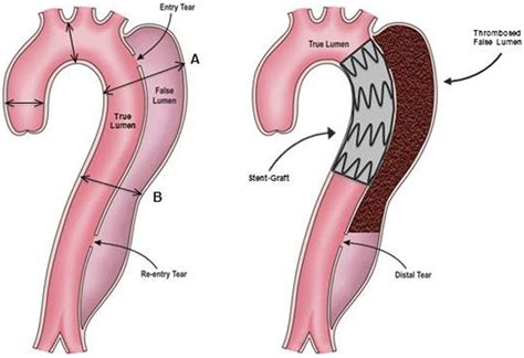 Endovascular Repair of Type B Aortic Dissection | Circulation ...