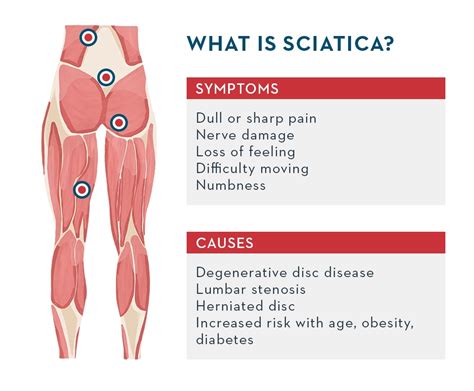 What is sciatica - symptoms and causes - and how to deal with it? - by ...