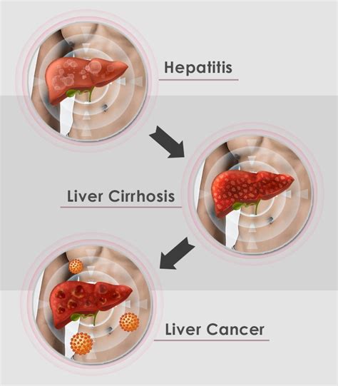 Treatment of liver disease | SP Health & Wellness