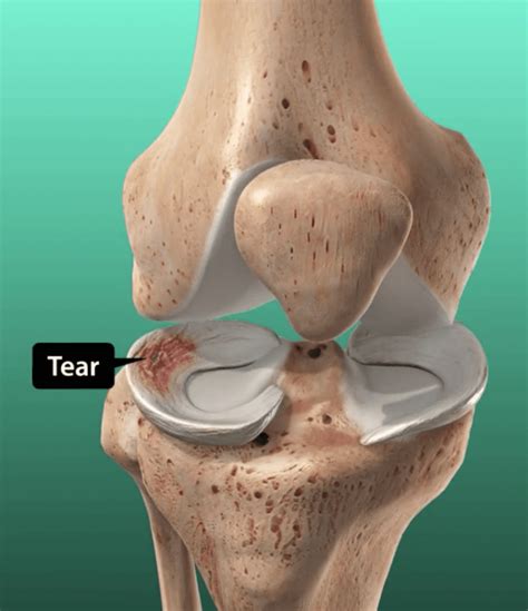 Meniscus Repair | Board Certified Orthopedic Surgeons