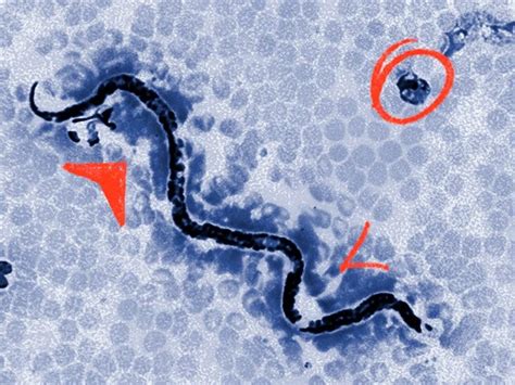 Hookworm In Human Eye