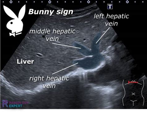 Abdominal ultrasound