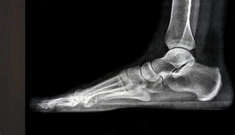 Foot X-Ray: Anatomy, Procedure & What to Expect