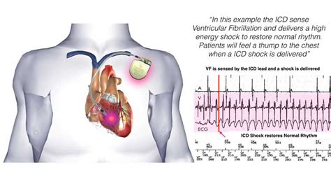 Implantable Cardioverter Defibrillator (ICD) General Information ...