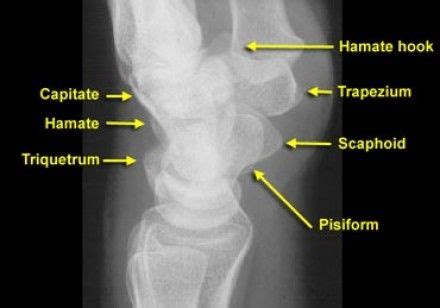 Carpels lateral labeled | Radiology, Emergency medicine, Wrist anatomy