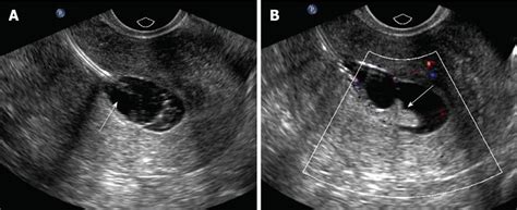 Sonohysterography: Principles, technique and role in diagnosis of ...