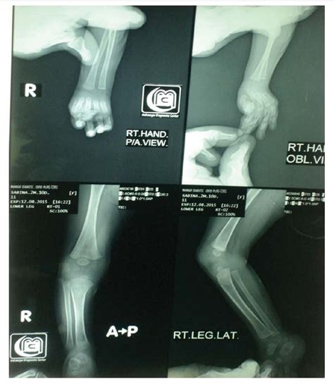 Figure 3 from Freeman-Sheldon Syndrome – A Case of Rare Observation ...