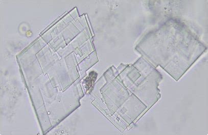 Cholesterol crystals in Urine | Medical Laboratories