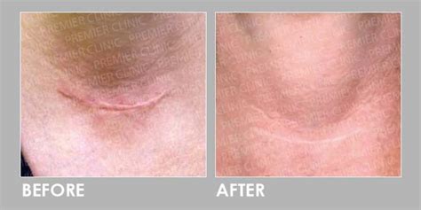 Vascular Laser - Advanced Keloid Scar Treatment - Premier Clinic