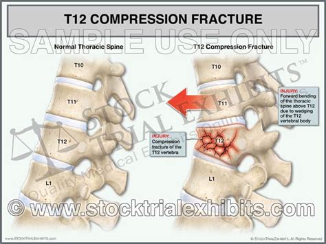 T12 Compression Fracture Compared to Normal Thoracic Spine – Stock ...