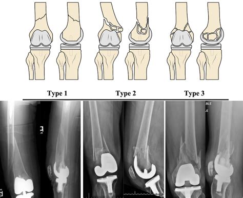 Pictorial and radiographic depictions of proposed distal femoral ...