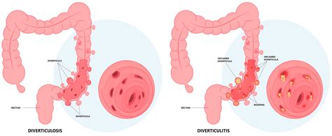 Diverticulosis Bleeding