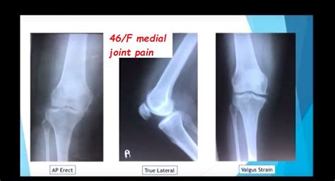 Unicondylar Knee Replacement — OrthopaedicPrinciples.com