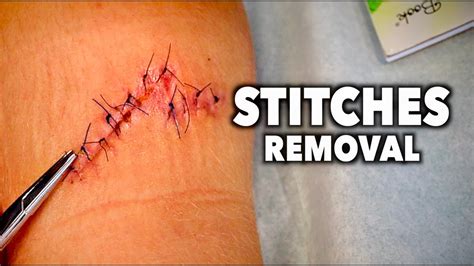 REMOVING 13 STITCHES (From a Huge Leg Wound) | Dr. Paul - YouTube