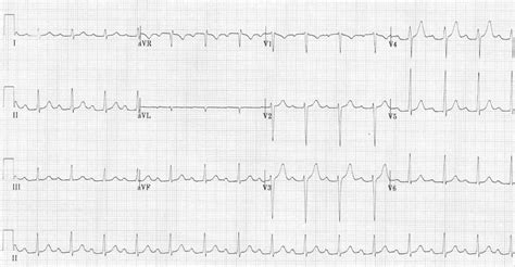 First Degree Heart Block • LITFL • ECG Library Diagnosis