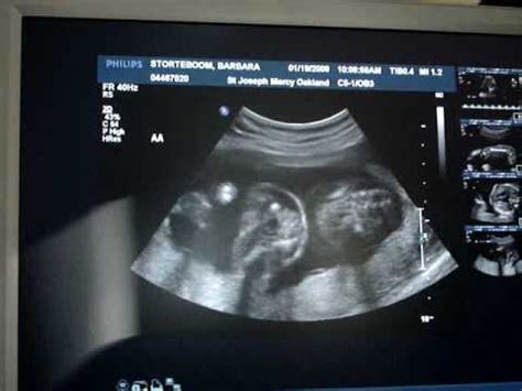 20 Weeks Pregnant Ultrasound Twins