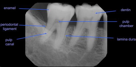 Radiographic Anatomy of Deciduous and Permanent Teeth & Eruption ...