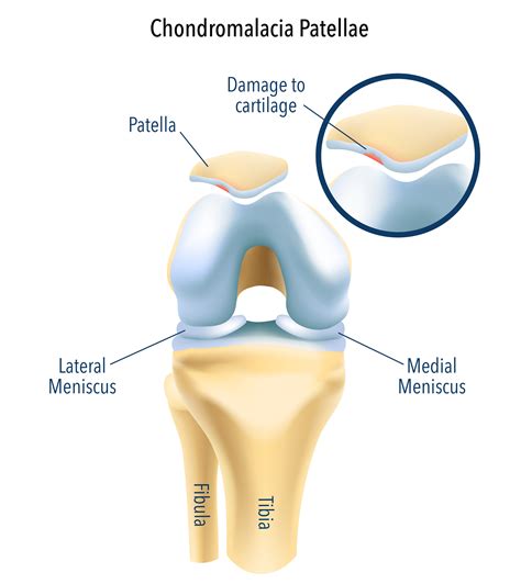 Chondromalacia Patella Treatment