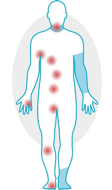 InterDry® – Intertrigo & Skin Fold Management