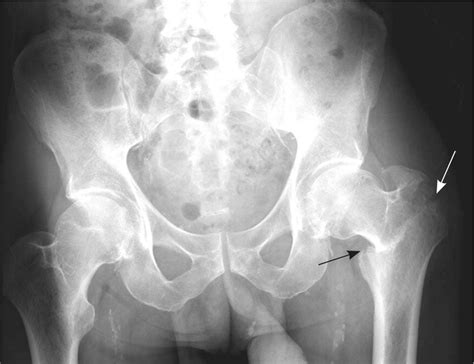 Have A Tips About How To Diagnose Hip Fracture - Icecarpet