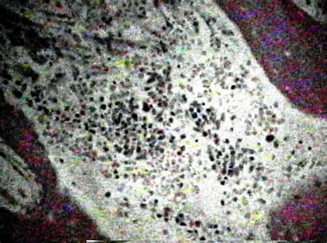 Histology of Ewing's Sarcoma : Wheeless' Textbook of Orthopaedics