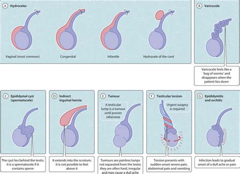 Testicular Cyst Vs Cancer