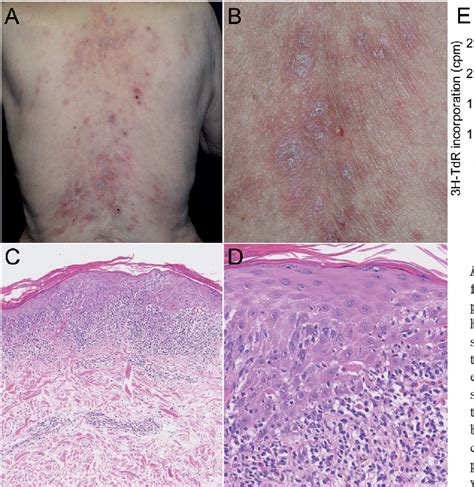 Figure 1 from A skin biopsy from a scaly erythematous Lichenoid Drug ...